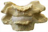 Cervical Degenerated Cervical Spine