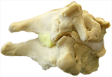 Cervical Degenerated Cervical Spine