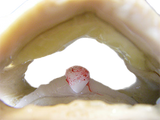 Cervical Degenerated Cervical Spine