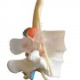 Lumbar Disc Herniation Model