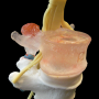 Lumbar Disc Herniation Model
