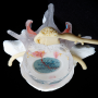 Lumbar Disc Herniation Model